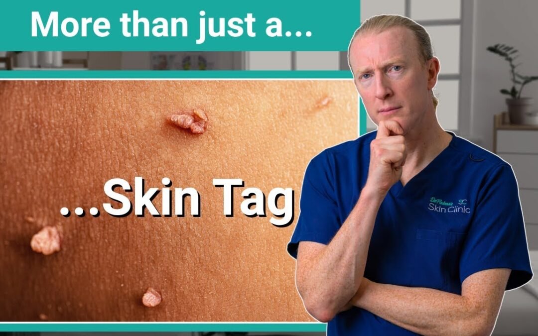Skin Tags links to Metabolic Health, Insulin resistance and diabetes...
